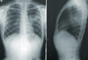 Have we found a cure for lung damage caused by air pollution?
